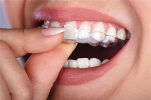 Clear Aligners